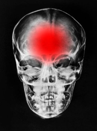 Image skull with brain damage