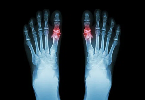 Gout  Film x-ray both foot and arthritis at first 